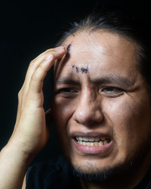 Portrait of a Latino man with 6 stitches on his forehead, having a string headache. A portrait of a Latino man with 6 stitches on his forehead, having a string headache.